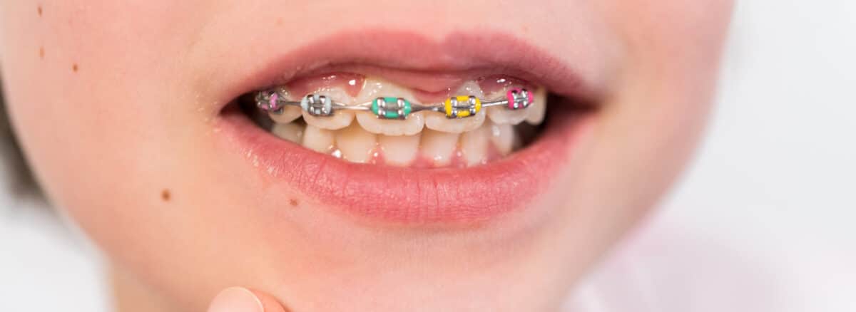 Close-up of the mouth of a young girl with rainbow braces.