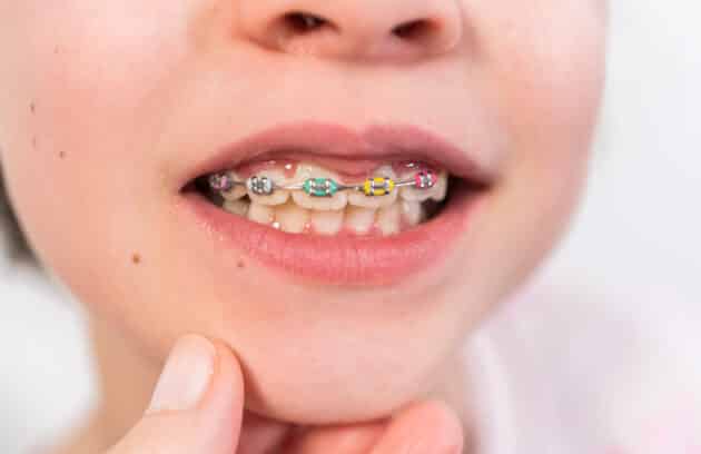 Close-up of the mouth of a young girl with rainbow braces.